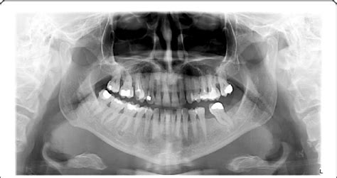 Panoramic Radiograph Of The First Patient Radiolucent Lesions In The