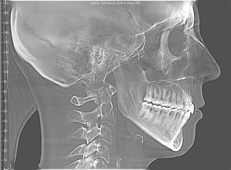 Posterior Open Bite After Treatment Rinvisalign
