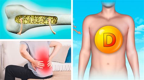 5 Sinais De DeficiÊncia De Vitamina D NÃo Ignore Youtube