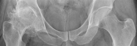 Simultaneous Bilateral Hip Replacement More Satisfactory And Better