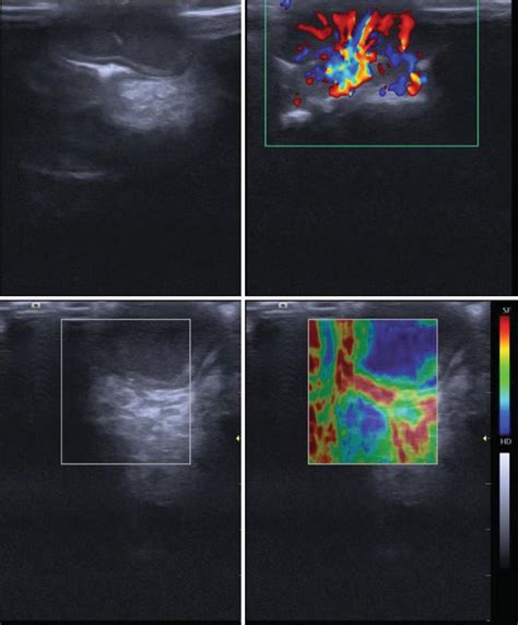 Of Ultrasonography In Maxillofacial Intraoral Benign And Malignant