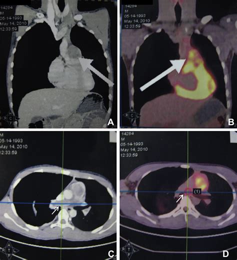 A Rare Case Of Primary Pulmonary Artery Myofibroblastic SarcomaImaging