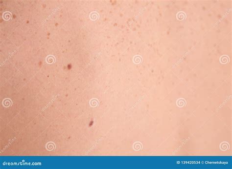 Person With Birthmarks Closeup View Stock Photo Image Of Doctor