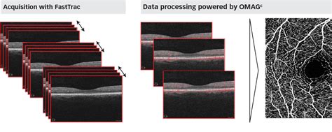 Figure From Angiographic Imaging Of Retinal Vasculature In Specific