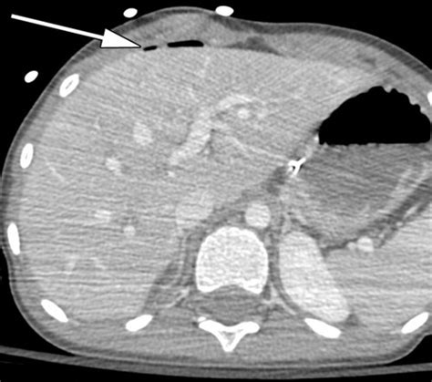 Multidetector CT of Blunt Abdominal Trauma | Radiology