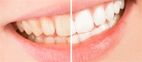 Coffee Stains Teeth? What You Should Know Before Your Next Cup - Newbury Dental Group