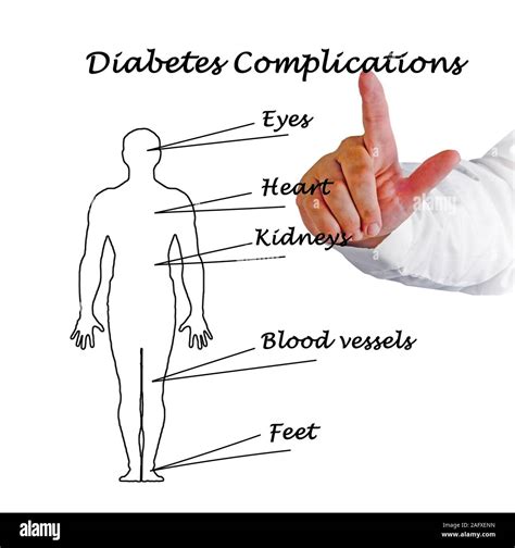 Diabetic Nephropathy Hi Res Stock Photography And Images Alamy