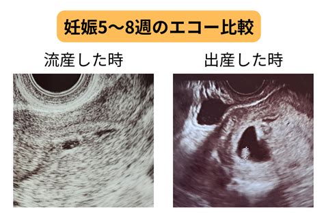 【エコー比較】流産した時出産した時の違いは？妊娠初期のエコーと症状を週別で比較 心配性olのマタニティブログ～妊娠・流産・子育ての記録～