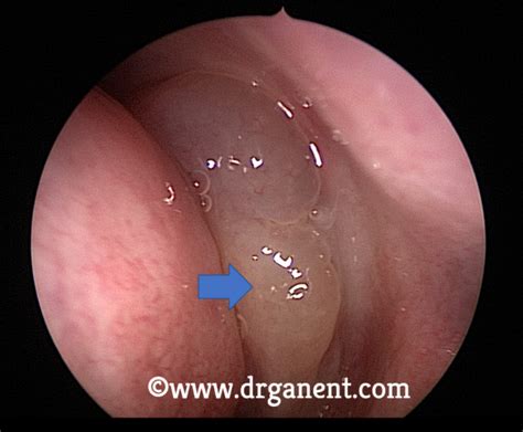 What Are Nasal Polyps Warning Graphic Medical Images And Video