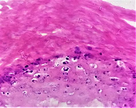 Verruca Plantaris Histology