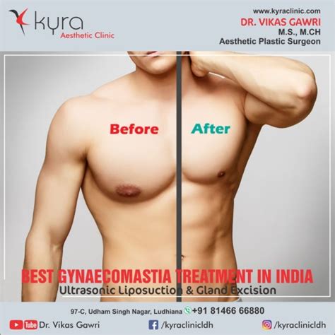 Treatment Options For Gynecomastia In Ludhiana