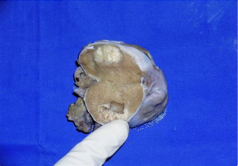 Figure 3 From Pure Testicular Teratoma Presenting As A Metastatic Germ