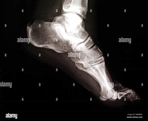 Normal Ankle Joint X Ray Hi Res Stock Photography And Images Alamy