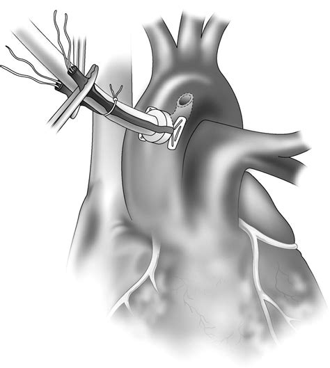 Cardiopulmonary Bypass Thoracic Key