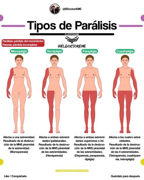 Mauricio Montelongo on Twitter TIPOS DE PARÁLISIS Diferencia entre