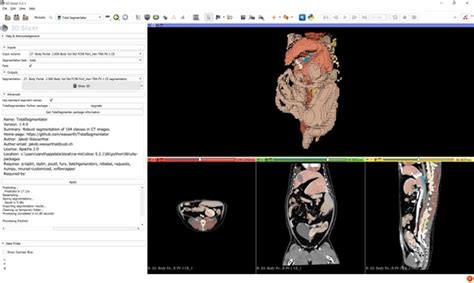 New Extension Fully Automatic Whole Body Ct Segmentation In 2 Minutes Using Totalsegmentator