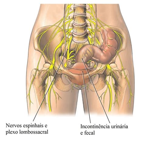 H Rnia De Disco Na Coluna Lombar Expulsa Central Ou Foraminal