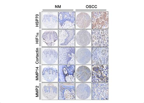 Expression Of Hsp Hif A Mmp Mmp And Cortactin In Oscc