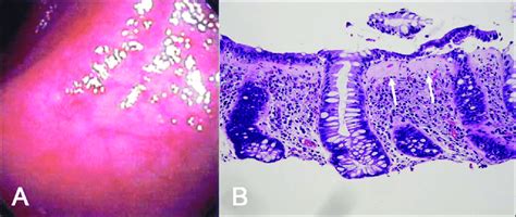 A Colonoscopic Image Of Collagenous Colitis Showing Minimal Mucosal Download Scientific Diagram