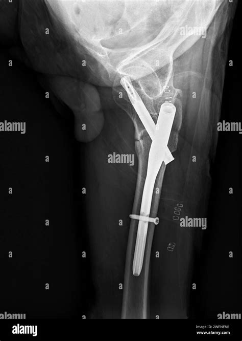 An X Ray Reveals Both Hip Joints With Hemiarthroplasty Showcasing The Success Of The Surgical