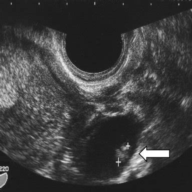 Laparoscopic findings: A swollen ampulla of the left fallopian tube is ...