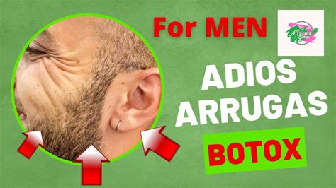 BOTOX EN HOMBRES Tecnica Y Zonas A Aplicar YouTube