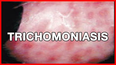 Early Signs And Symptoms Of Trichomoniasis Vaginitis Cure And Treatment Youtube