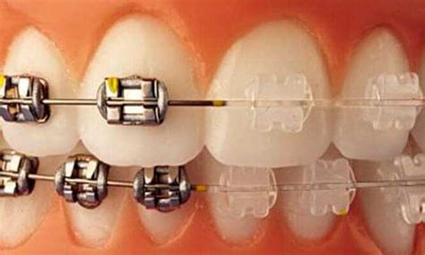 Tipos De Brackets Cl Nica Dental Fabi N L Pez