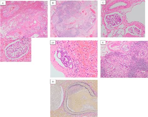 Histopathological Findings A Multiple Lymphovascular Invasion Of