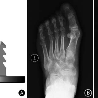 (PDF) Metallic resurfacing hemiarthroplasty of the first metatarsophalangeal joint combined with ...