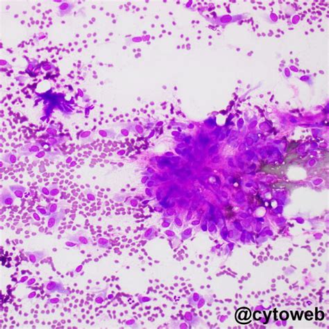 October 2020: A spindly neck lump | Cytoweb – Practical Cytopathology