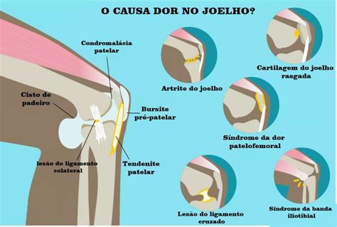 Dor No Joelho Causas Tratamento E Quando Consultar Um Médico Dicas De Saúde