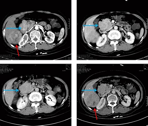 Abdominal Computed Tomography CT Images A Non Contrast CT Image B