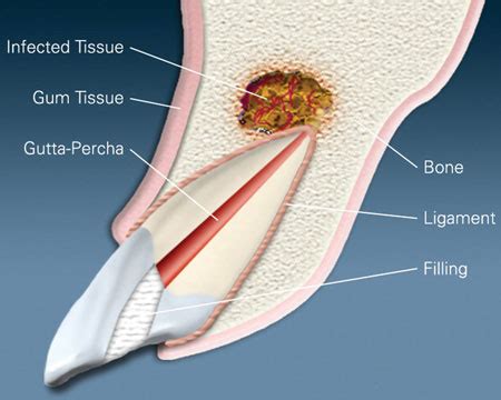 Apicoectomy West Des Moines and Ankeny | Surgical Root Canal