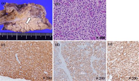 Figure3 Histological And Immunohistological Findings Of The Tumor At