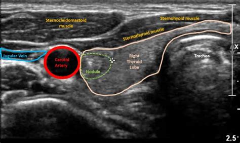 Thyroid Ultrasound: Purpose and Procedure | Healthtian