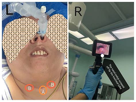 Endoscopic Nasal Polyp Removal Youtube