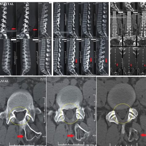 ct scan   lumbar spine   levels sagittal  axial