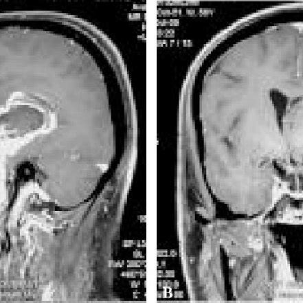 Postoperative Magnetic Resonance Imaging Scan Postcontrastaxial