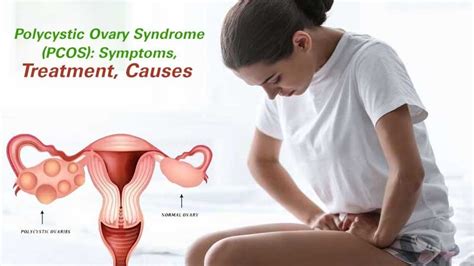 Pcos Polycystic Ovary Syndrome Symptoms And Treatment