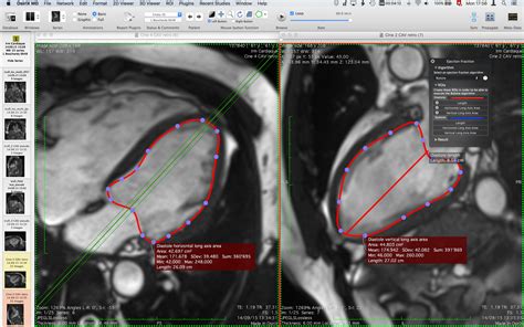 Osirix Dicom Viewer Plugins