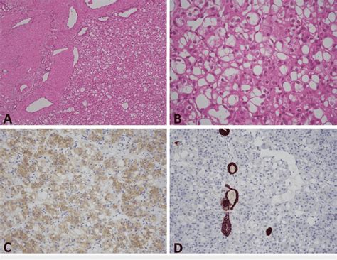 A Tumor Shows A Solid Growth Pattern With Large Thickwalled Vessels