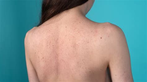 Back Acne Treatment बढ़ती गर्मी में पसीने के कारण पीठ पर हो गए हैं