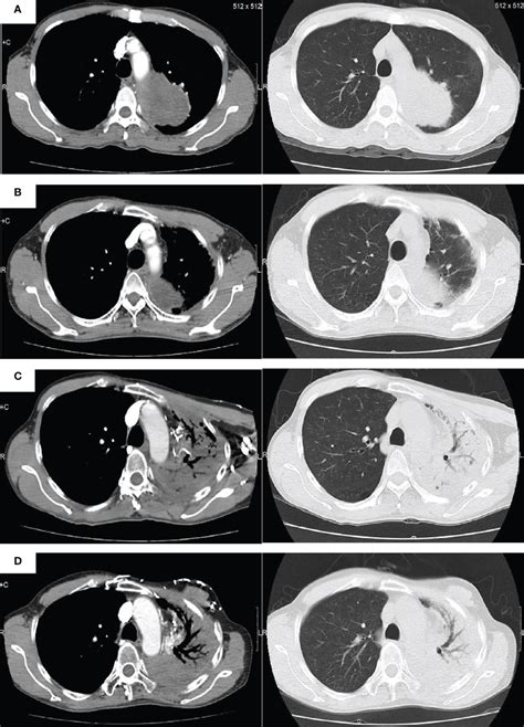 Radiologic Images Of The Pulmonary Blastoma Patient A Baseline