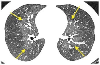 Pulmonary Vascular Diseases Radiology Key