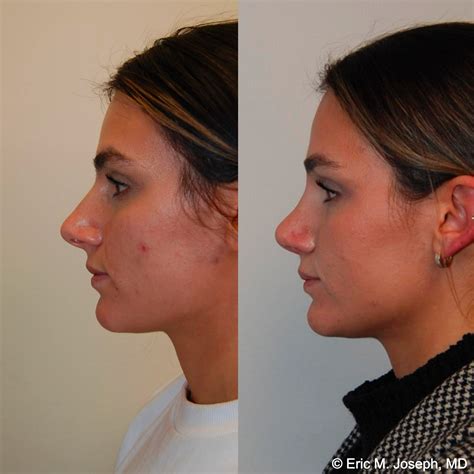 Eric M Joseph Md Rhinoplasty Before After Results With