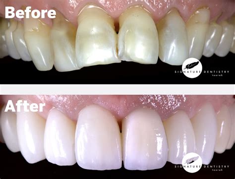 Porcelain Veneers Melbourne Cost Of Veneers Signature Dentistry