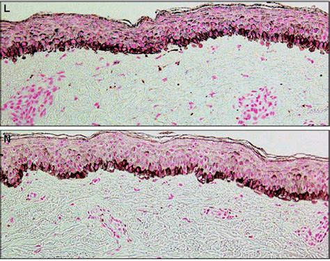 Increased Epidermal Pigmentation Is The Hallmark Of Melasma