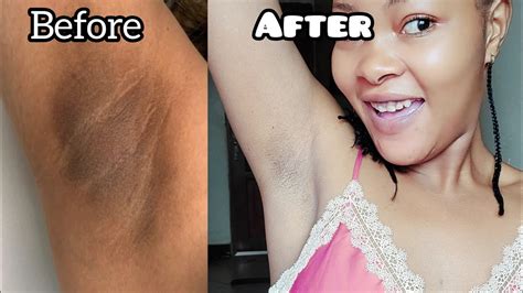 How To Lighten Dark Underarms Naturally And Fast In 2 Days Effective Results Youtube