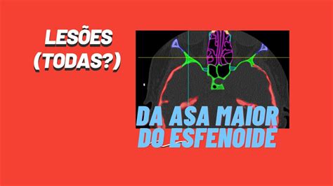 Asa Maior Do Esfenoide Anatomia E Patologia Na Tomografia